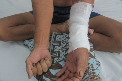 Đắp thuốc vô tội vạ, có thể phải cắt bỏ tay chân